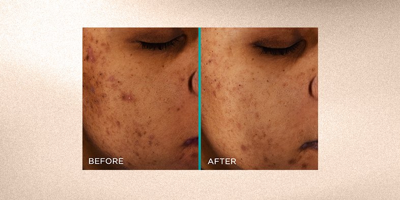 Close-up of face showing sun spots on skin before and after using L’Oréal Paris Bright Reveal Dark Spot Serum